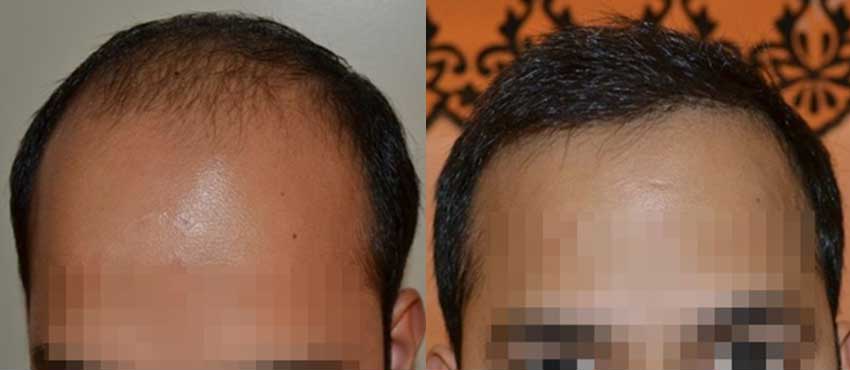 DHI before & after hair transplant results