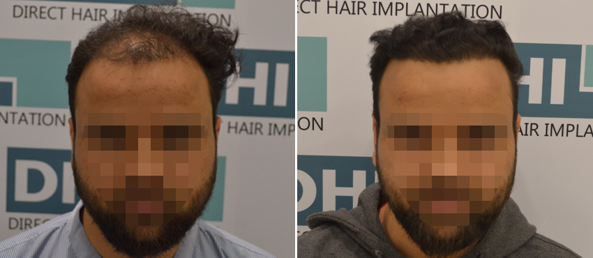 DHI before & after hair transplant results