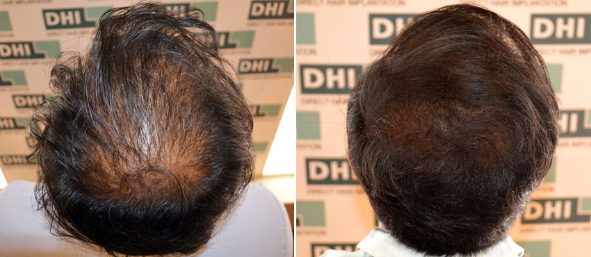 DHI before & after hair transplant results