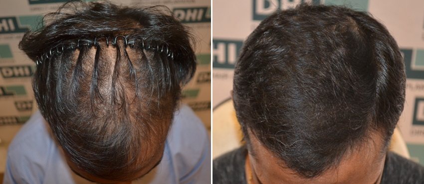 DHI before & after hair transplant results