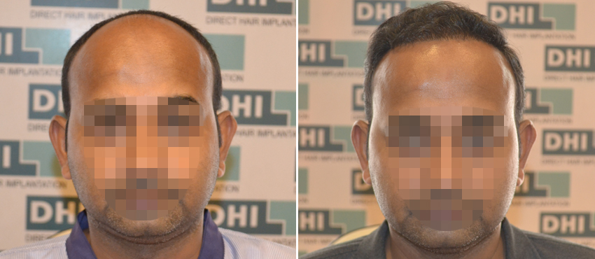 DHI before & after hair transplant results