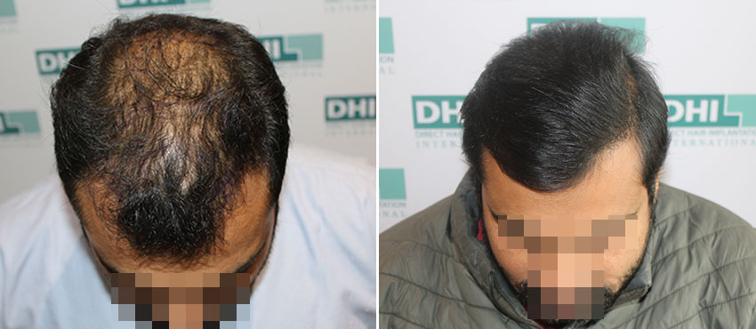 DHI before & after hair transplant results