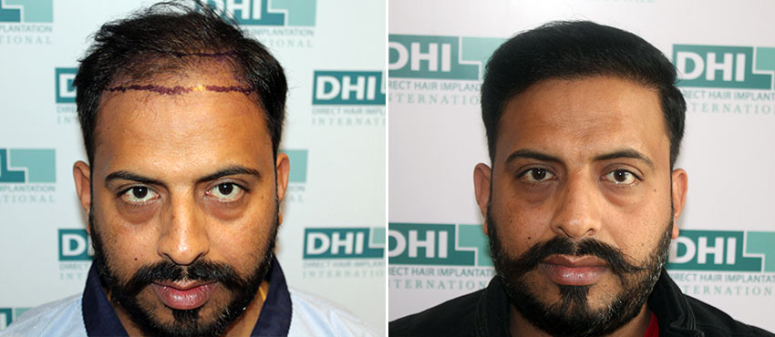 DHI before & after hair transplant results