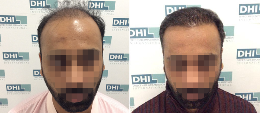 DHI before & after hair transplant results