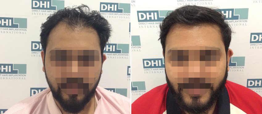 DHI before & after hair transplant results