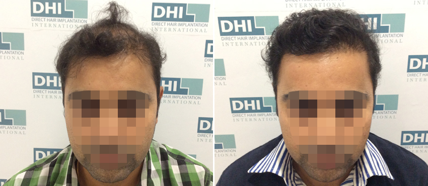 DHI before & after hair transplant results