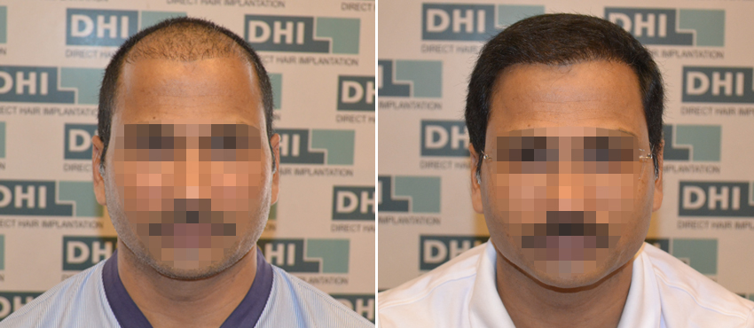 DHI before & after hair transplant results