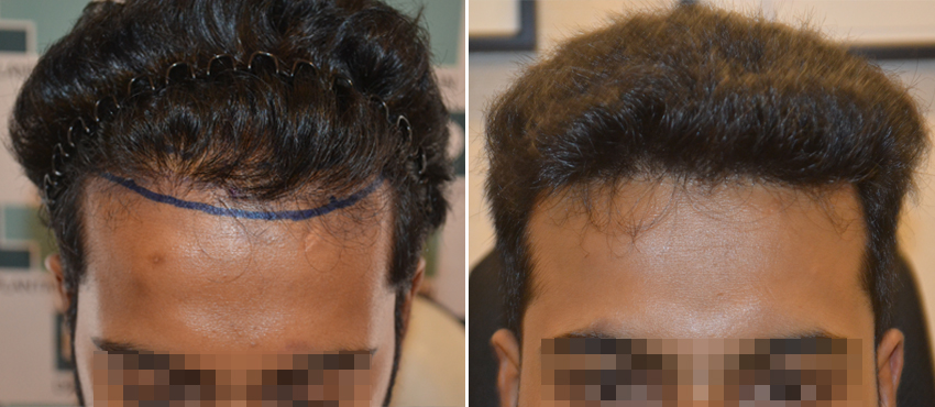 DHI before & after hair transplant results