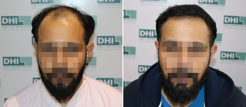 DHI before & after hair transplant results