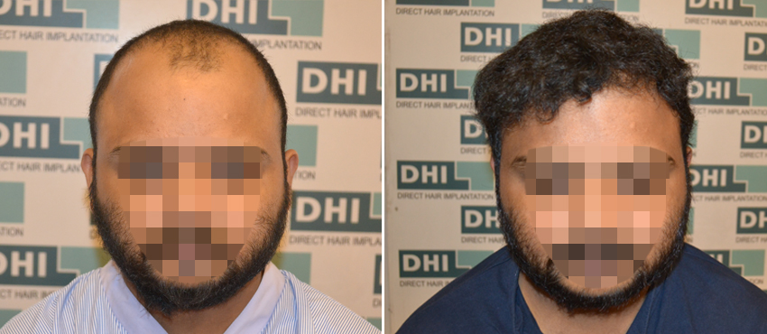 DHI before & after hair transplant results