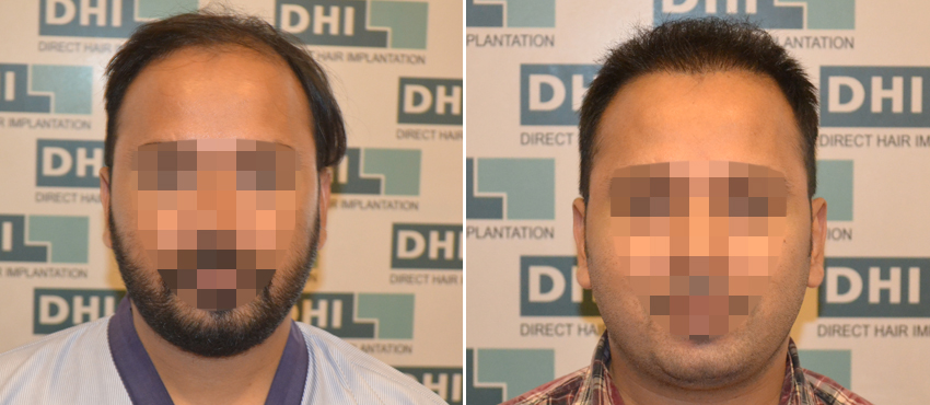 DHI before & after hair transplant results