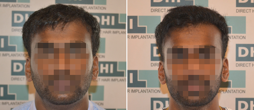 DHI before & after hair transplant results