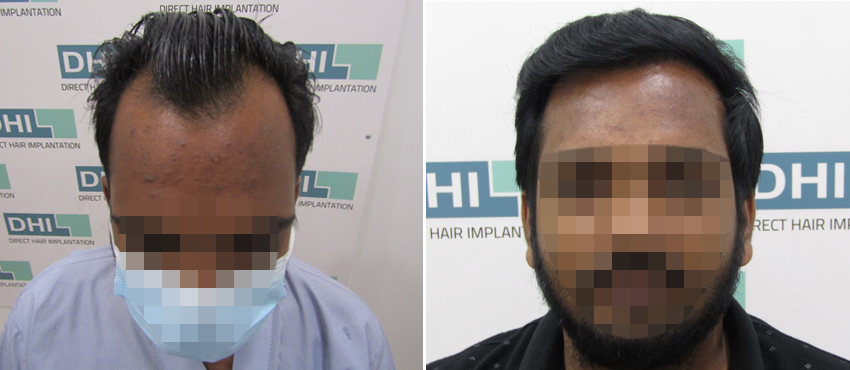 DHI before & after hair transplant results