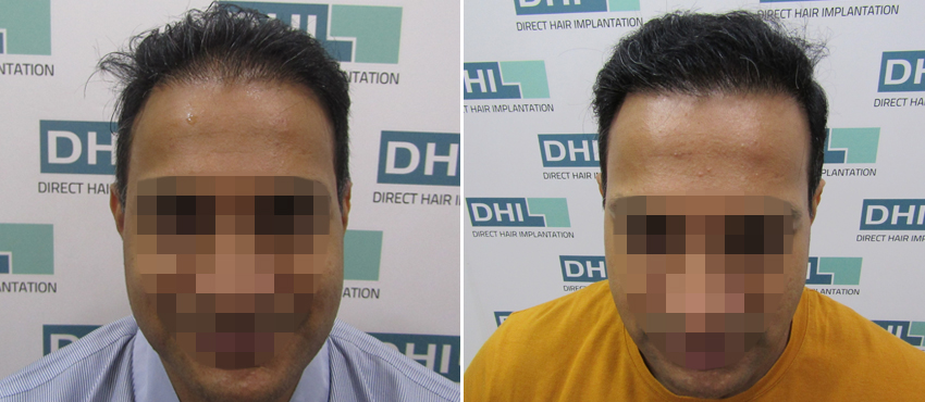 DHI before & after hair transplant results