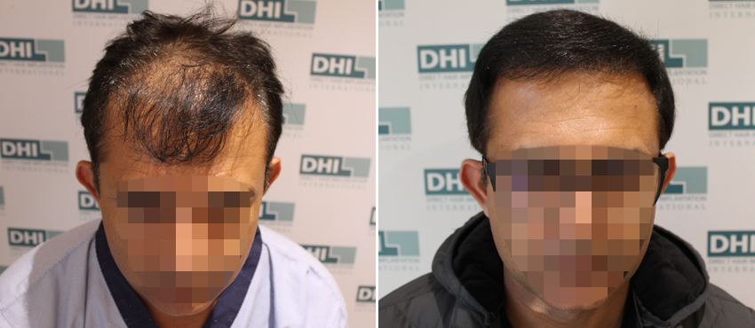 DHI before & after hair transplant results