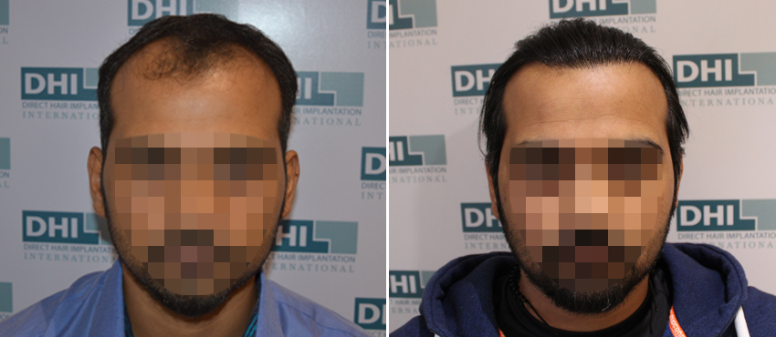 DHI before & after hair transplant results