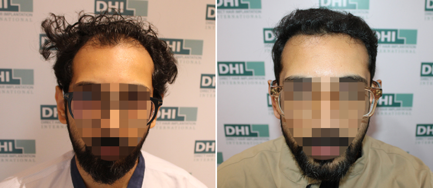 DHI before & after hair transplant results