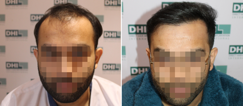 DHI before & after hair transplant results