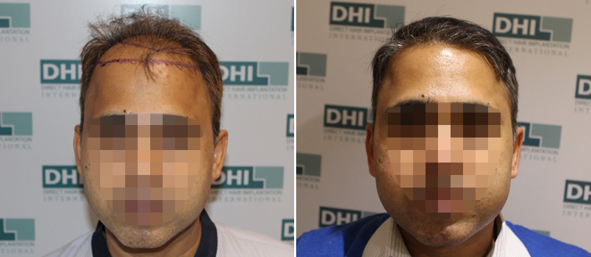 DHI before & after hair transplant results