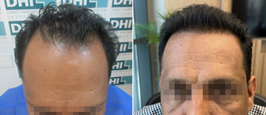 DHI before & after hair transplant results