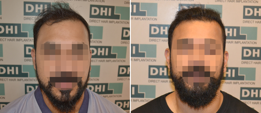 DHI before & after hair transplant results