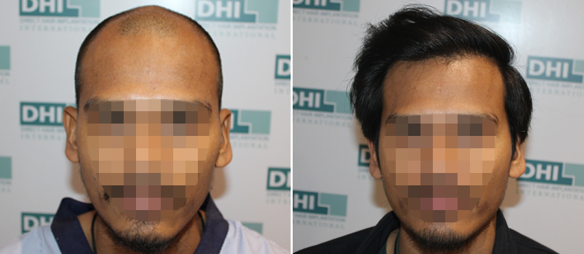 DHI before & after hair transplant results