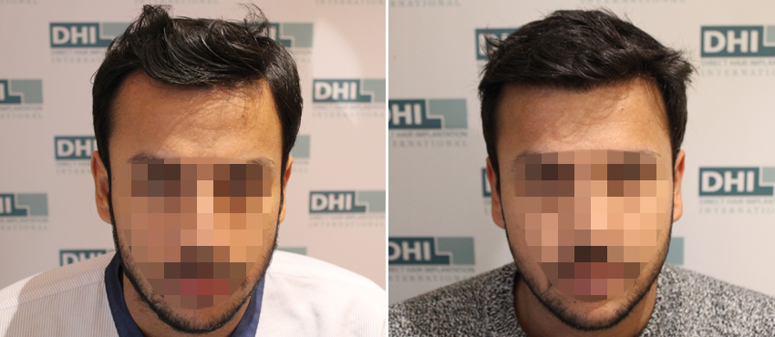 DHI before & after hair transplant results