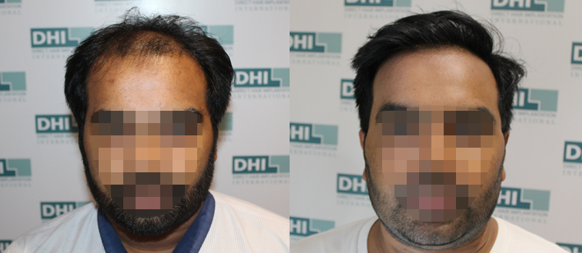 DHI before & after hair transplant results