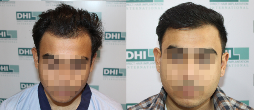 DHI before & after hair transplant results