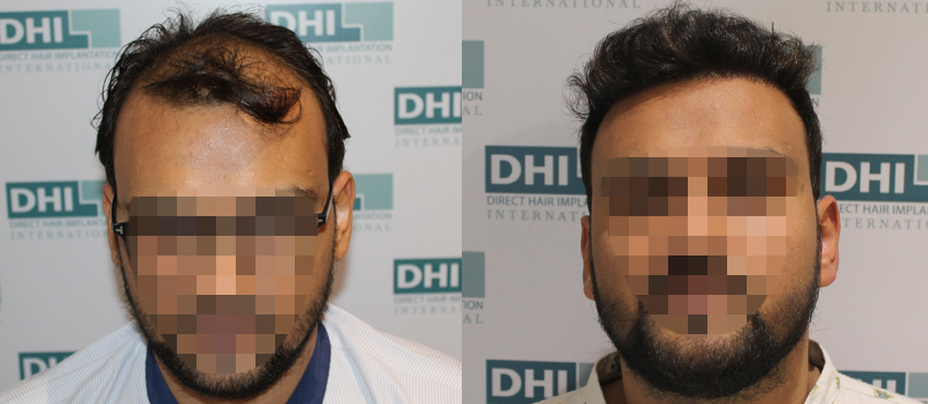 DHI before & after hair transplant results