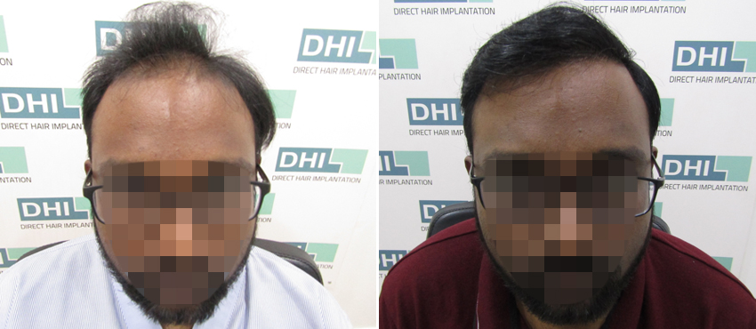 DHI before & after hair transplant results