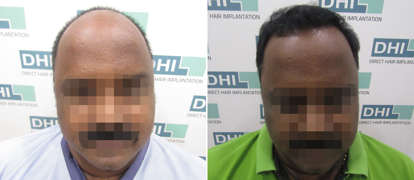 DHI before & after hair transplant results