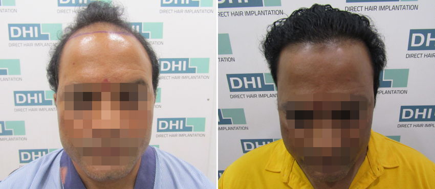 DHI before & after hair transplant results