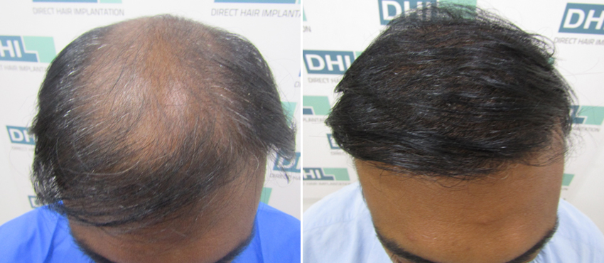 DHI before & after hair transplant results