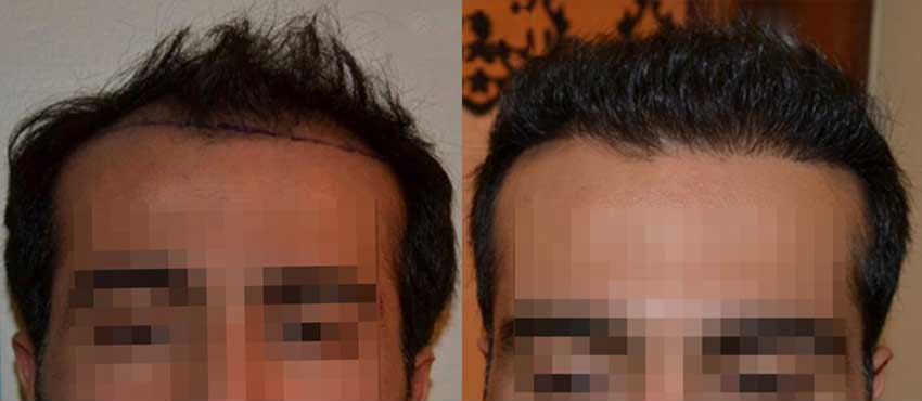 DHI before & after hair transplant results