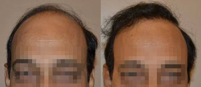 DHI before & after hair transplant results