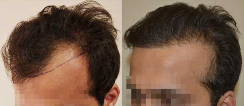 DHI before & after hair transplant results