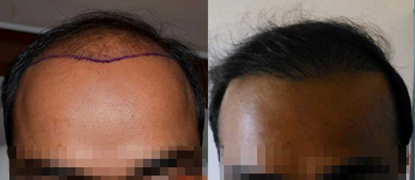 DHI before & after hair transplant results