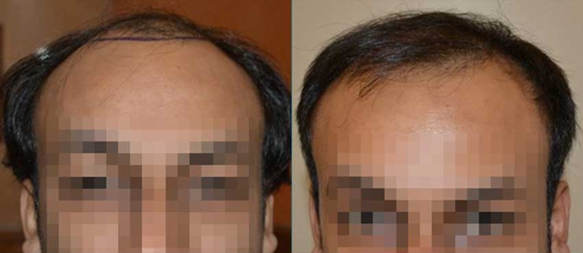 DHI before & after hair transplant results