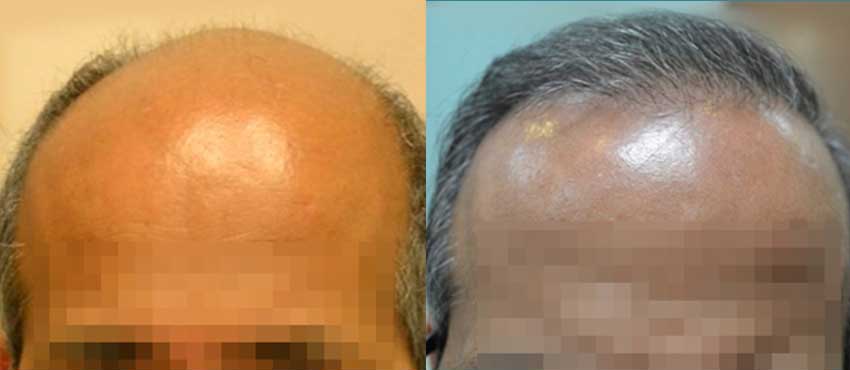 DHI before & after hair transplant results