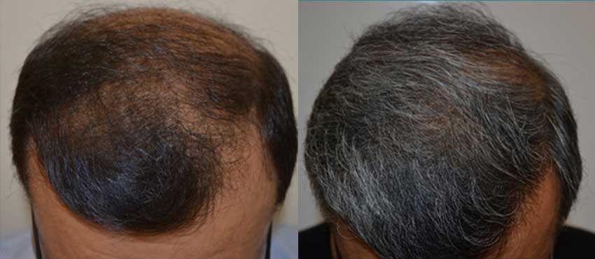 DHI before & after hair transplant results