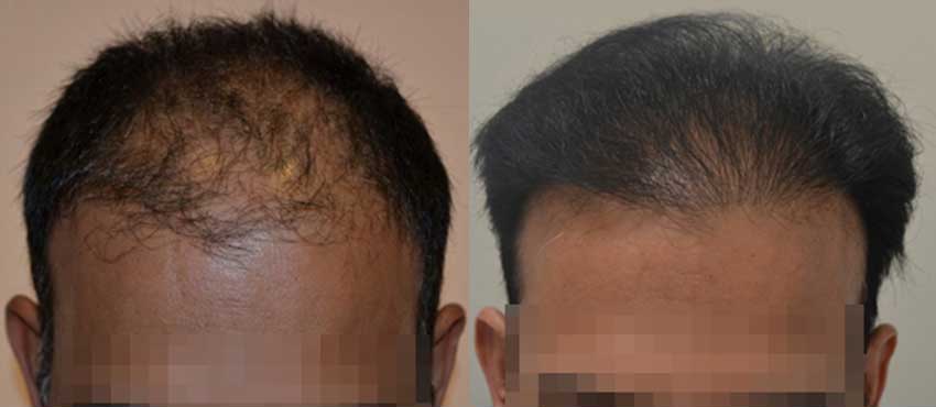 DHI before & after hair transplant results