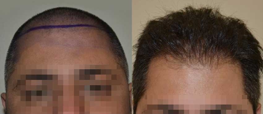 DHI before & after hair transplant results