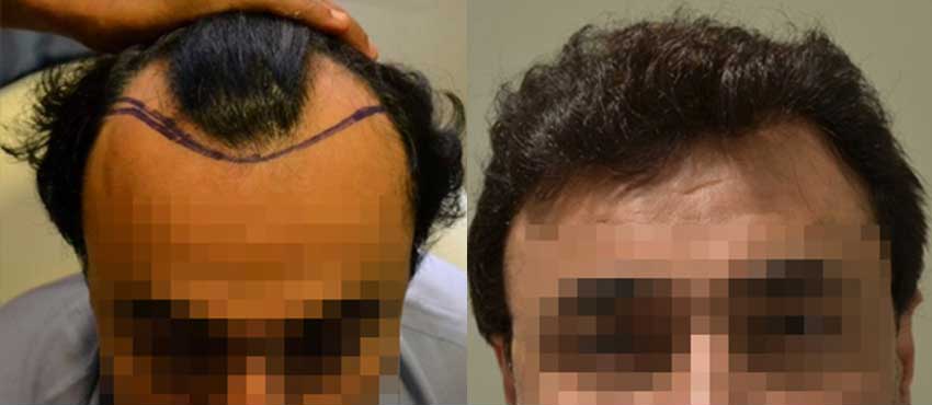 DHI before & after hair transplant results