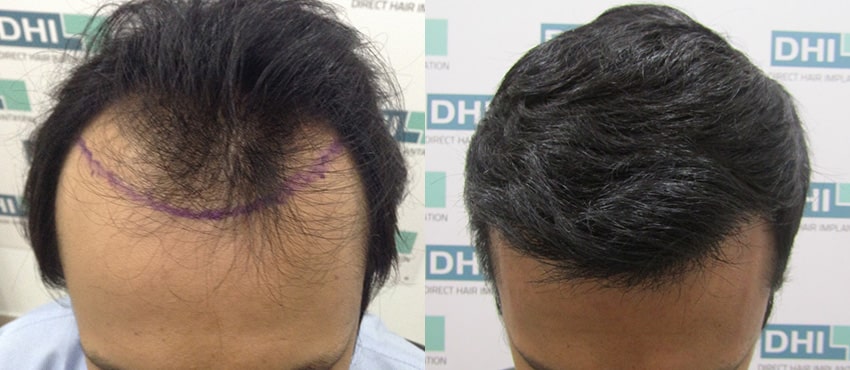 DHI before & after hair transplant results