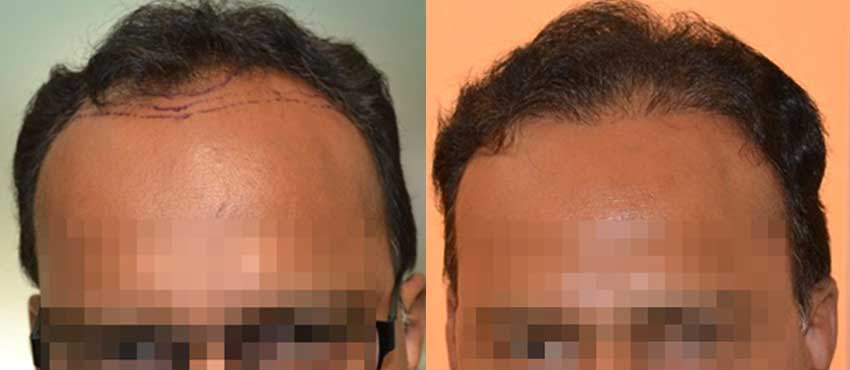 DHI before & after hair transplant results