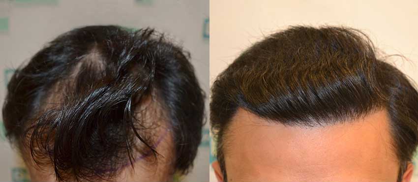 DHI before & after hair transplant results