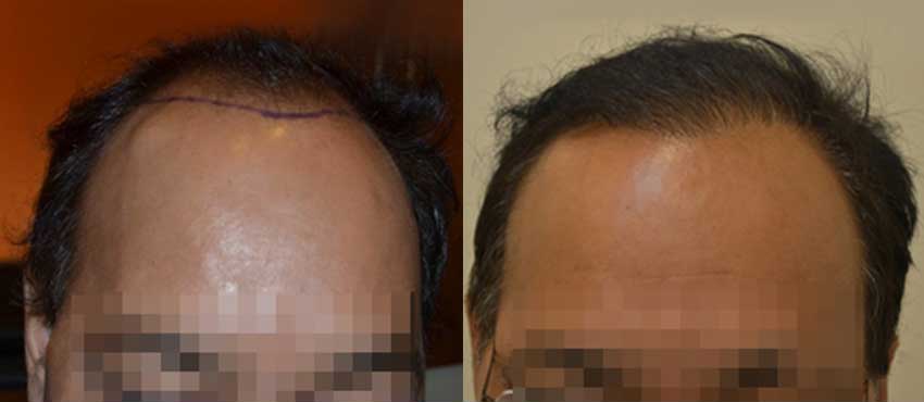 DHI before & after hair transplant results