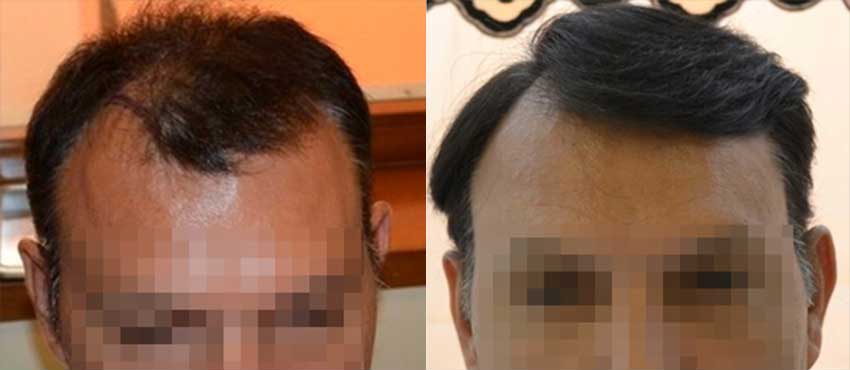 DHI before & after hair transplant results