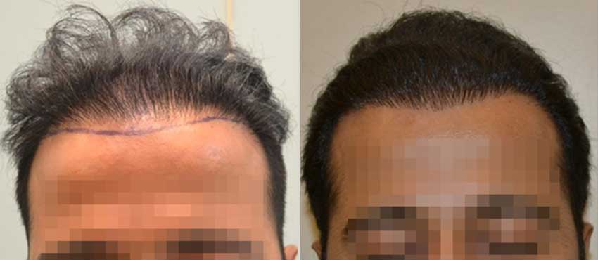 DHI before & after hair transplant results